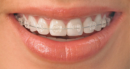 Niềng răng chỉnh khớp cắn theo những phương pháp nào ?