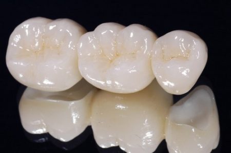 Những đặc điểm của răng sứ titan ?