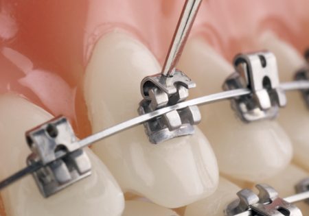 Giới thiệu các loại mắc cài tự đóng trong niềng răng 2 Giới thiệu các loại mắc cài tự đóng trong niềng răng 2