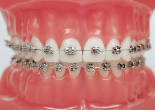 Niềng răng có tác dụng gì? 2 Niềng răng có tác dụng gì? 2