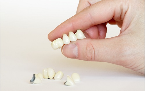 Bọc răng sứ Titan giá bao nhiêu? 1 Bọc răng sứ Titan giá bao nhiêu? 1