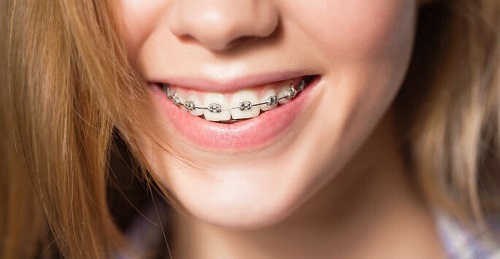 Có thể niềng răng một hàm hay không bác sĩ Nha khoa? 2 Có thể niềng răng một hàm hay không bác sĩ Nha khoa? 2