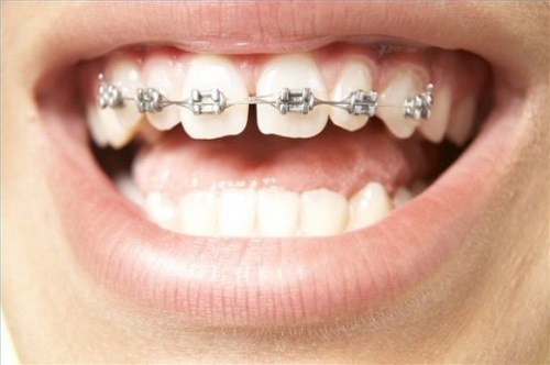 Có thể niềng răng một hàm hay không? 1 Có thể niềng răng một hàm hay không? 1