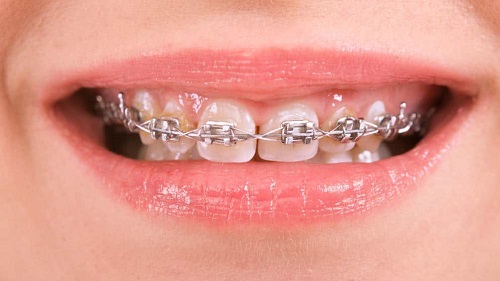 Khắc phục răng hô móm lệch lạc 3 Khắc phục răng hô móm lệch lạc 3