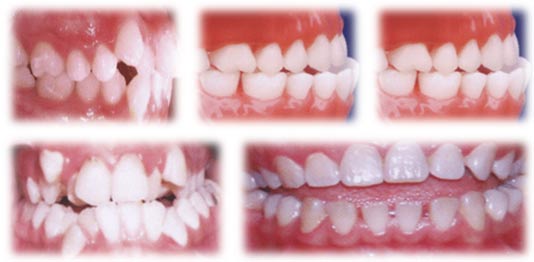 Khắc phục răng hô, móm, lệch lạc 1 Khắc phục răng hô, móm, lệch lạc 1