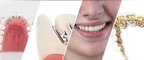 Niềng răng khấp khểnh mất bao lâu thì hoàn tất? 2 Niềng răng khấp khểnh mất bao lâu thì hoàn tất? 2