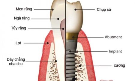 Phương pháp trồng răng giả tồn tại lâu dài 2 Phương pháp trồng răng giả tồn tại lâu dài 2