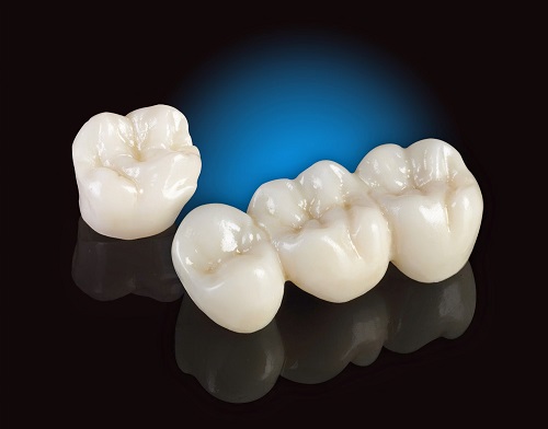 Những ưu điểm của phục hình răng sứ thẩm mỹ 1 Những ưu điểm của phục hình răng sứ thẩm mỹ 1