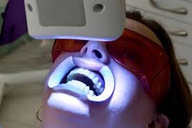 Tẩy trắng răng bằng đèn Laser 2 Tẩy trắng răng bằng đèn Laser 2