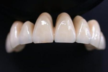 4 lưu ý khi làm răng sứ thẩm mỹ 1 4 lưu ý khi làm răng sứ thẩm mỹ 1