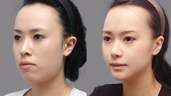 Chỉnh nha niềng răng cho trường hợp rằng hô 2 Chỉnh nha niềng răng cho trường hợp rằng hô 2