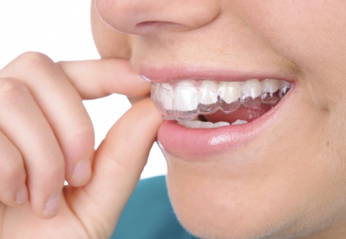 Chỉnh nha niềng răng cho trường hợp rằng hô 1 Chỉnh nha niềng răng cho trường hợp rằng hô 1