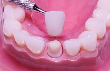 Dán răng sứ Veneer có ưu điểm gì ?