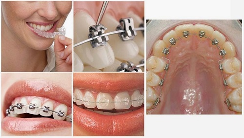 Những tác dụng quan trọng của niềng răng 1 Những tác dụng quan trọng của niềng răng 1