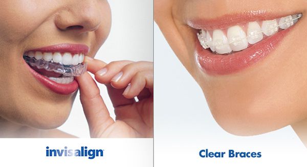 Chi phí niềng răng không mắc cài 3D Clear 1 Chi phí niềng răng không mắc cài 3D Clear 1