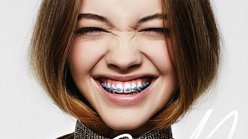 Ưu điểm của các loại mắc cài niềng răng 2 Ưu điểm của các loại mắc cài niềng răng 2