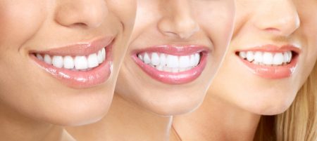 Những điều cần biết về bọc răng sứ 3 Những điều cần biết về bọc răng sứ 3