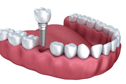 Chi phí cấy ghép Implant bao nhiêu tiền? 1 Chi phí cấy ghép Implant bao nhiêu tiền? 1