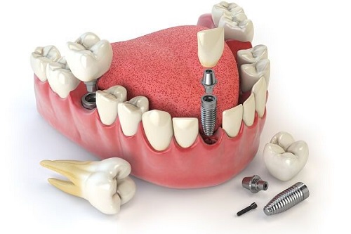 Chi phí cấy ghép Implant có thực sự cao không? 1 Chi phí cấy ghép Implant có thực sự cao không? 1