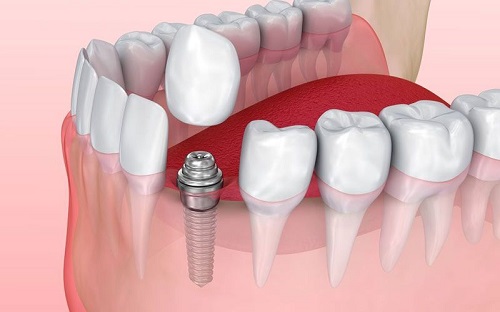 Do đâu mà cấy Implant được nhiều người ưa chuộng? 1 Do đâu mà cấy Implant được nhiều người ưa chuộng? 1