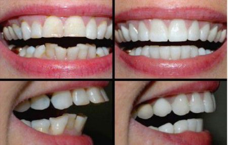 Niềng răng nhanh 1 niềng răng nhanh 1