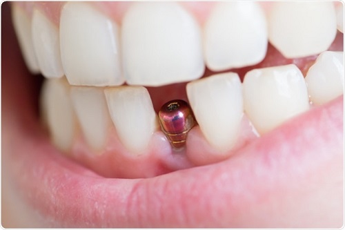 Phục hình răng sứ trong cấy ghép Implant 1