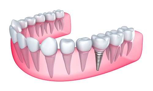 Trồng răng Implant có gây hại cho cơ thể không? 1 Trồng răng Implant có gây hại cho cơ thể không? 1