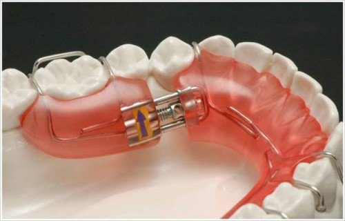 Chỉnh nha tháo lắp có ốc nong rộng 1 Chỉnh nha tháo lắp có ốc nong rộng 1