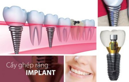 Trồng răng implant là gì?