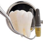 Cấy ghép răng với Implant có hiệu quả không ?