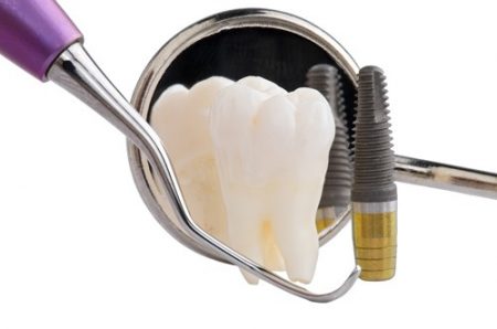 Cấy ghép răng với Implant có hiệu quả không ?