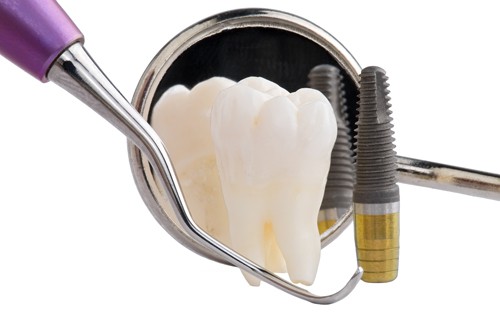 Các bước thực hiện cấy ghép răng Implant 1