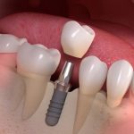 Cấy ghép Implant ở đâu tốt và uy tín ?