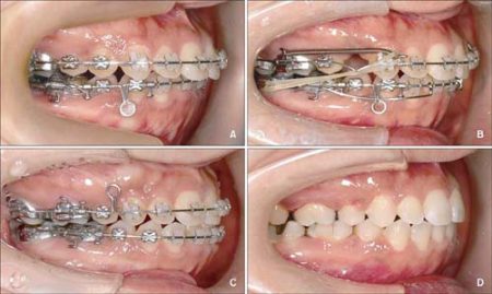 niềng 4 răng cửa