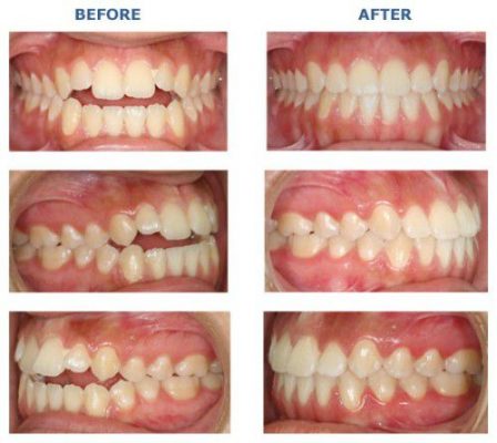 niềng 4 răng cửa có được không