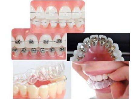 Niềng răng 1 hàm giá bao nhiêu? 2 Niềng răng 1 hàm giá bao nhiêu? 2