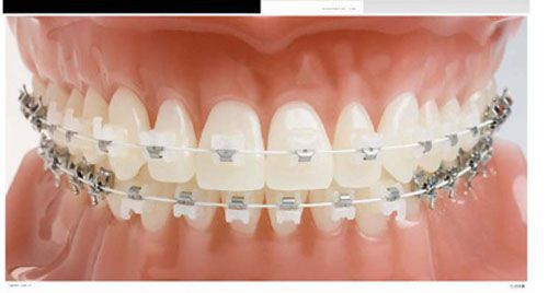 Niềng răng chỉnh nha với phương pháp gắn mắc cài 2