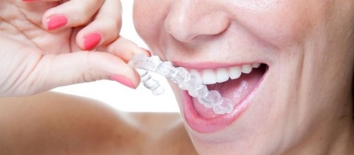 Niềng răng invisalign là gì? 3 Niềng răng invisalign là gì? 3
