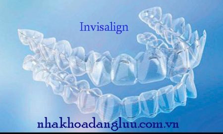 niềng răng invisalign tại việt nam như thế nào