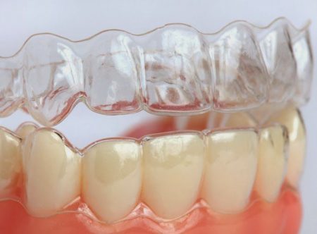 niềng răng invisalign tại việt nam như thế nào ?