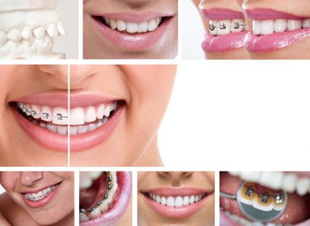Niềng răng chỉnh nha hiệu quả nhất ở đâu? 1 Niềng răng chỉnh nha hiệu quả nhất ở đâu? 1
