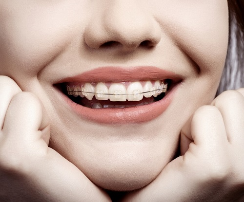 Niềng răng móm 1 Niềng răng móm 1