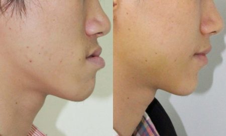 niềng răng móm như thế nào