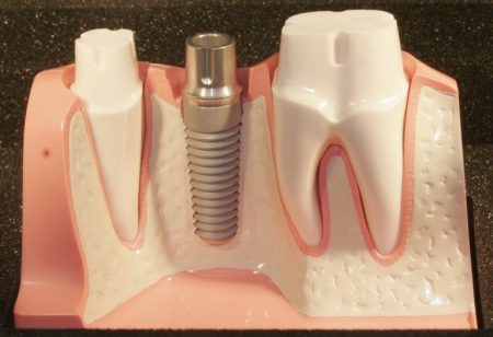 5 lợi ích tuyệt vời của trồng răng Implant 1 5 lợi ích tuyệt vời của trồng răng Implant 1