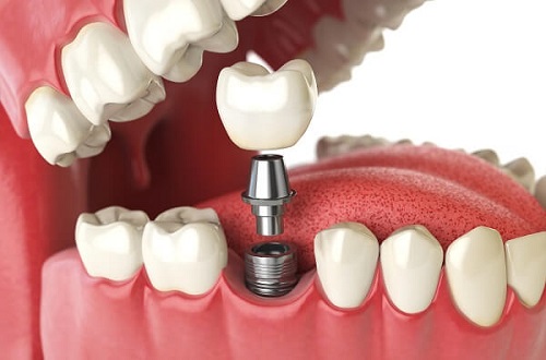 Trồng răng Implant có đau và nguy hiểm không? 1 Trồng răng Implant có đau và nguy hiểm không? 1