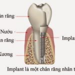 Cấy ghép Implant nên thực hiện vào lúc nào-1