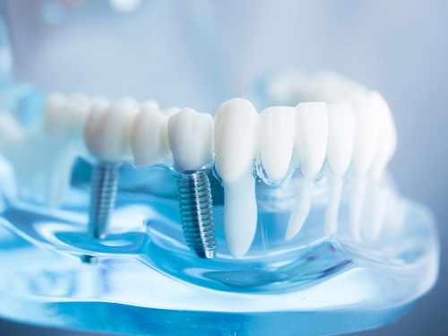 Sự ra đời của răng sứ thẩm mỹ không kim loại 1 Sự ra đời của răng sứ thẩm mỹ không kim loại 1