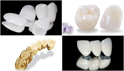 Bọc răng sứ Venus có đem lại hiệu quả không? 1 Bọc răng sứ Venus có đem lại hiệu quả không? 1