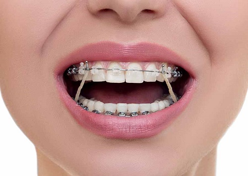 Có nên niềng răng cho người trưởng thành? 2 Có nên niềng răng cho người trưởng thành? 2