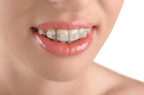 Răng hô có niềng được không? 3 Răng hô có niềng được không? 3